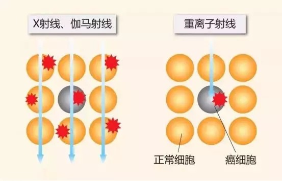 質(zhì)子重離子技術(shù)醫療險可以報銷(xiāo)嗎？
