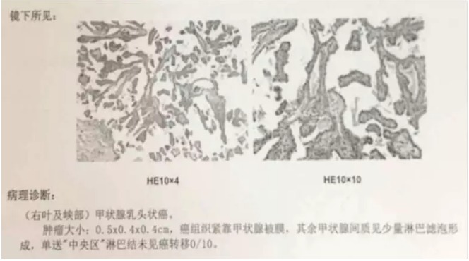 別慌，甲狀腺疾病還可以這樣投保！